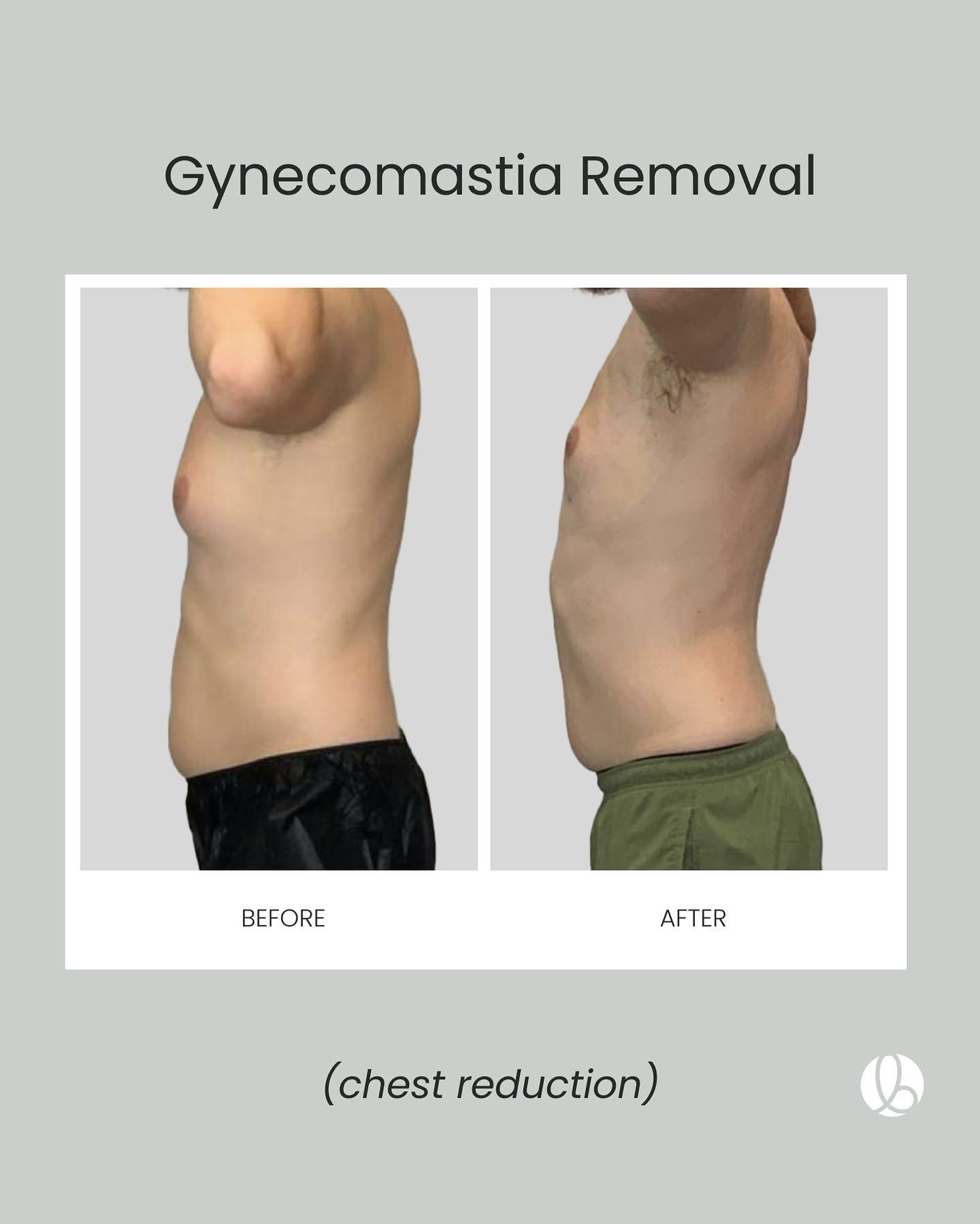 Gynaecomastia removal before-and-after side views of male torso, showing chest reduction.