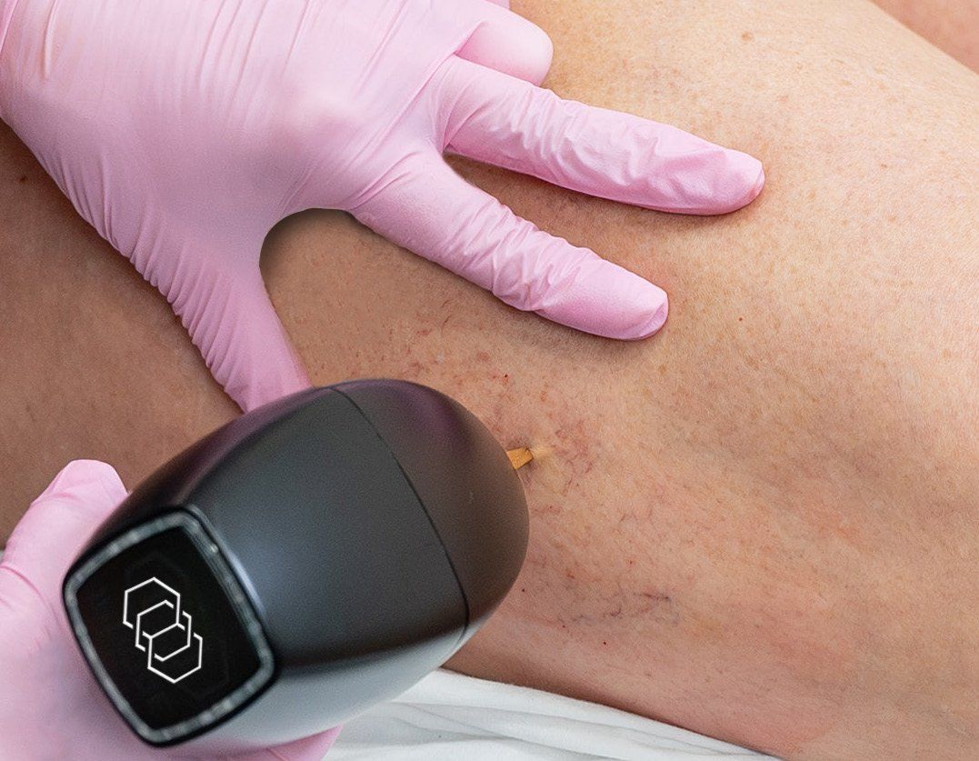 A provider treating spider veins on a patient's thigh with the VasculazeMAX handpiece