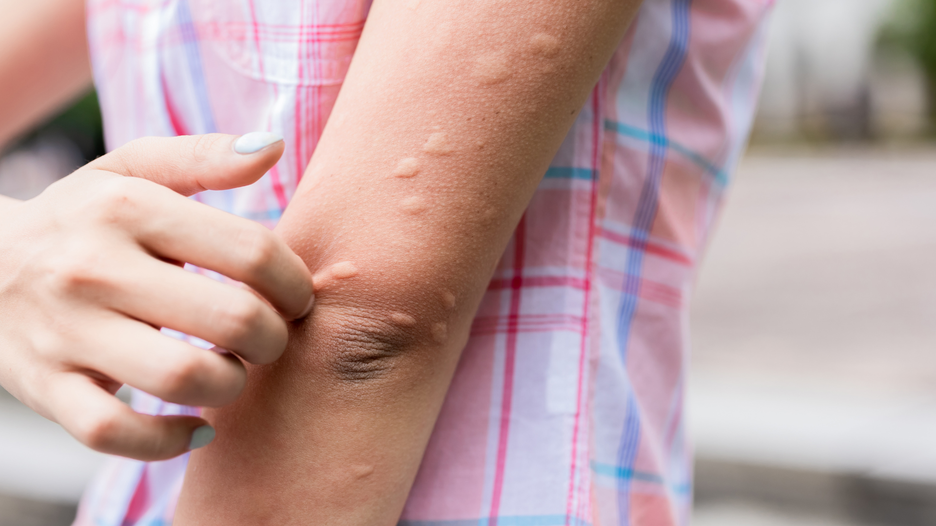 A woman is scratching her arm with mosquito bites.