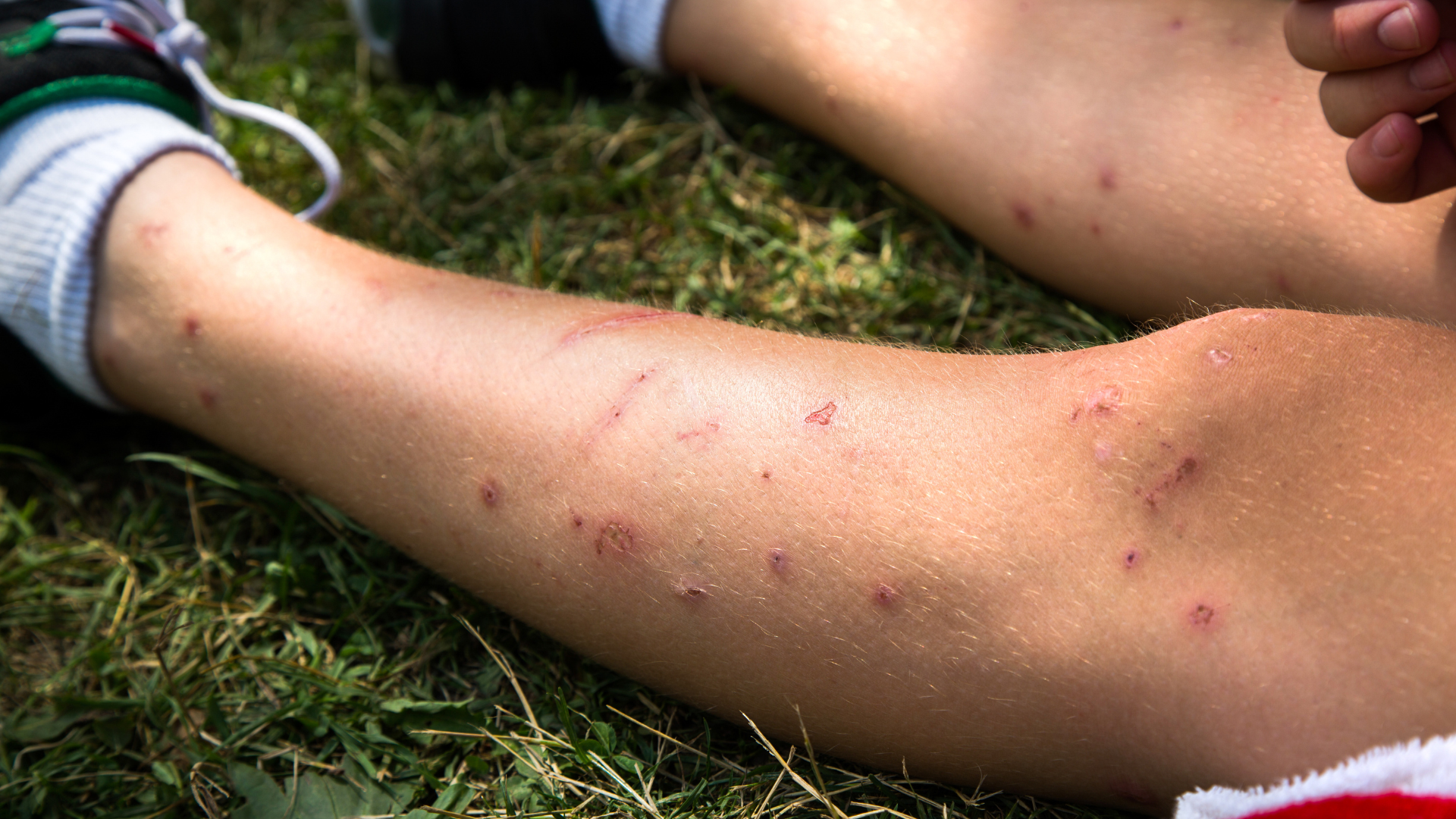 A person laying on the grass with mosquito bites on their legs.