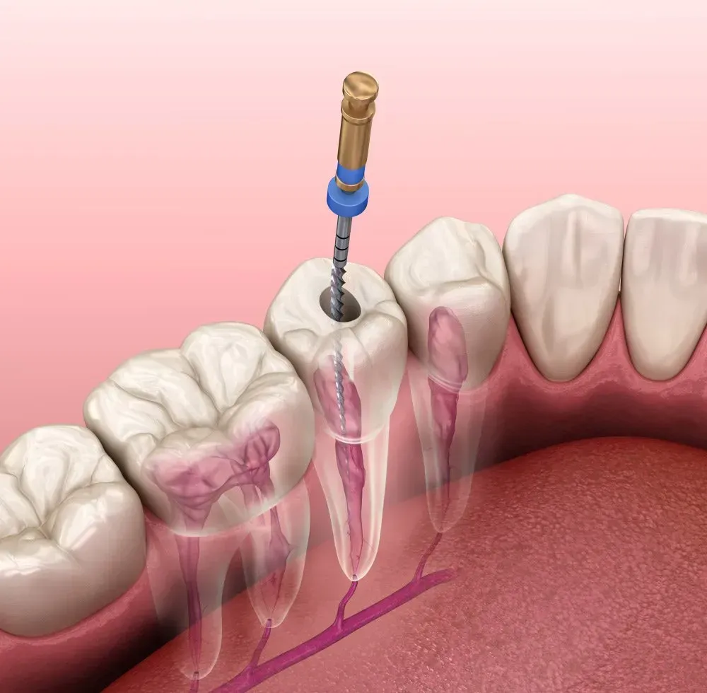 A Tool is Inserted Into a Tooth, Visualizing Root Canals — Maitland Dental Care in Maitland, NSW