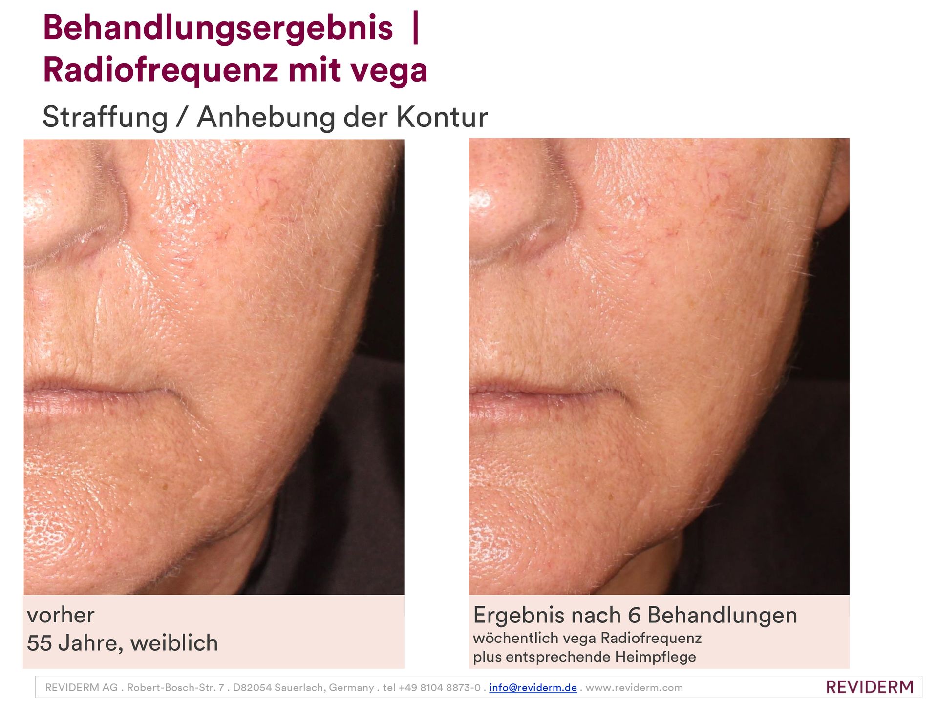 Ein Vorher-Nachher-Foto vom Gesicht einer Frau