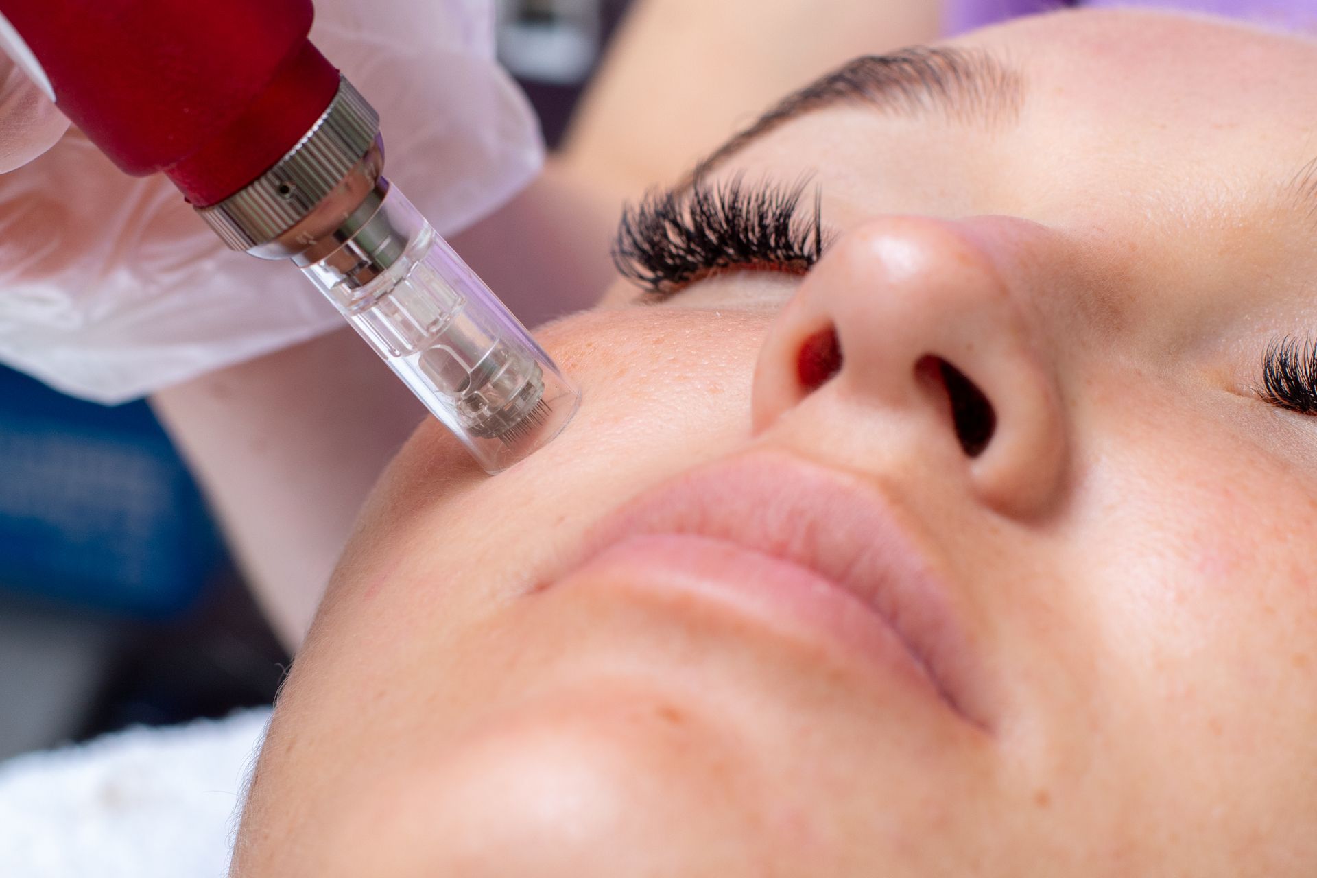 Person receiving microneedling treatment on the cheek; device held by gloved hand.