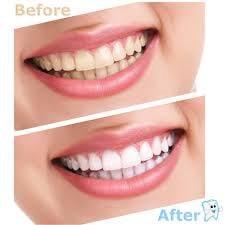 DRA. AMPARO PEÑA MARTIN DEL CAMPO - Blanqueamiento dental