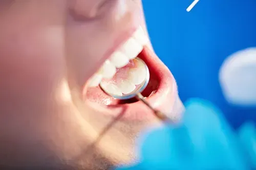 Información de valor sobre los problemas de caries y encías y cómo evitarlos