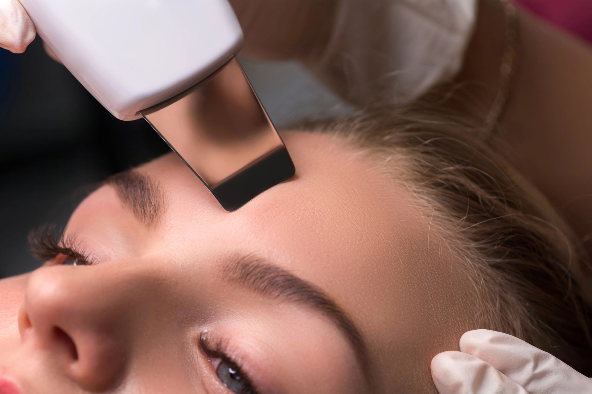Trattamento laser della pelle sulla fronte di una donna con un dispositivo portatile e mani guantate.