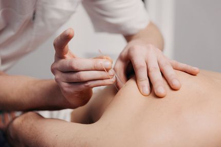 A person is getting acupuncture on their back.