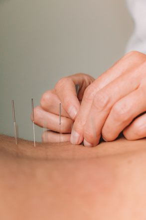 A person is getting acupuncture on their back.