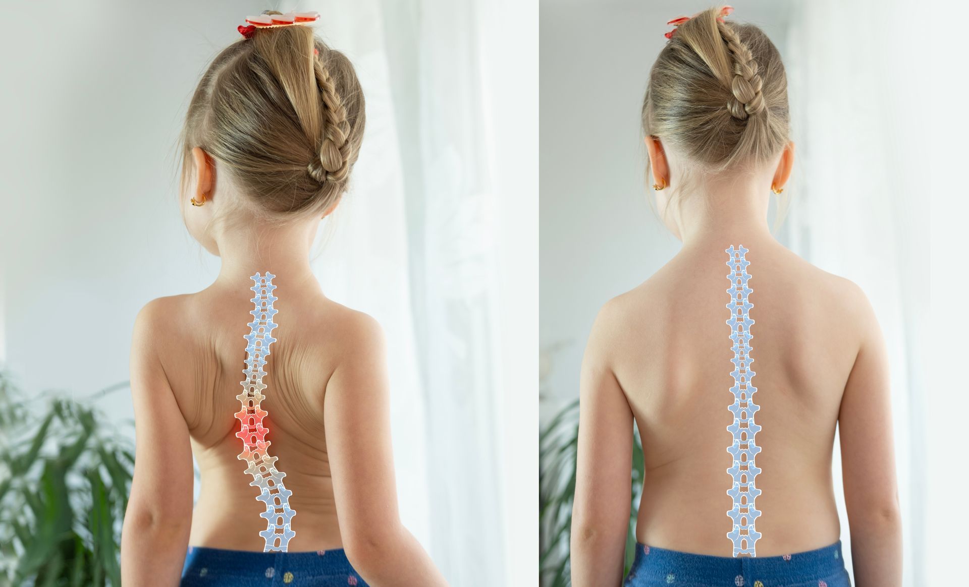 A before and after picture of a little girl with a scoliosis.
