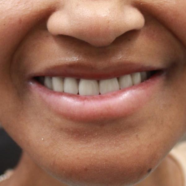 A close up of a woman 's mouth with her teeth showing