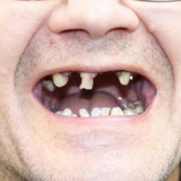 A close up of a man 's mouth with missing teeth