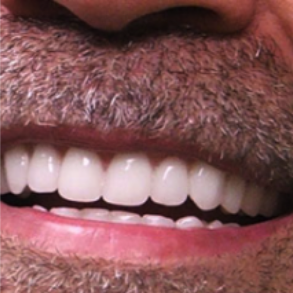 A close up of a man 's mouth with white teeth