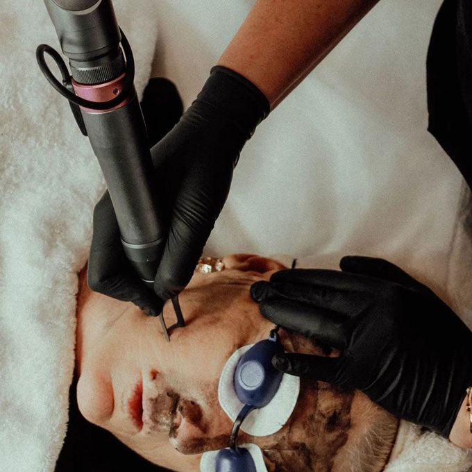 A Woman Is Having A Carbon Laser Facial — Beauty & Laser by Sarah in Long Jetty, NSW
