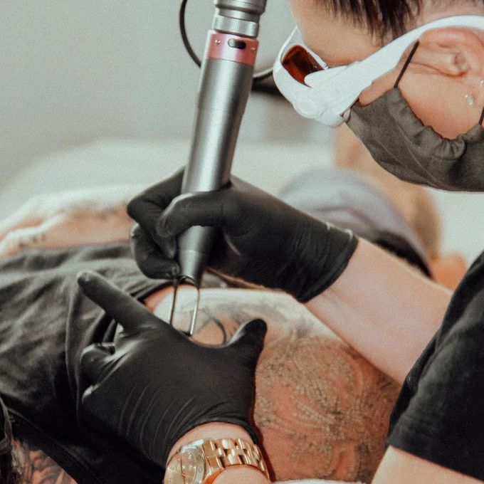 A Person Wearing A Mask And Gloves Is Getting A Tattoo Removed — Beauty & Laser by Sarah in Long Jetty, NSW