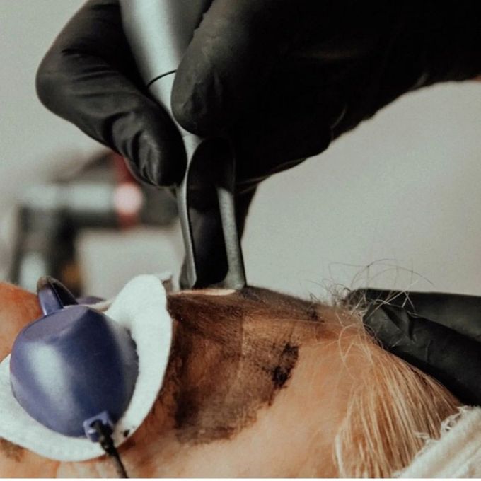 A Woman Is Getting A Laser Treatment On Her Face — Beauty & Laser by Sarah in Long Jetty, NSW