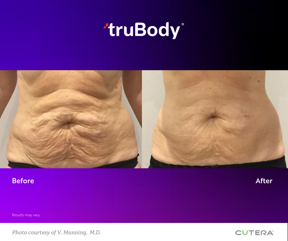 Body Contouring Jacksonville, FL Precision Medicine and Wellness by Elizabeth Bagan, APRN