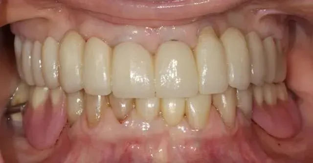 Close-up of a mouth with teeth and gums visible, showing pink tissue and dental alignment.