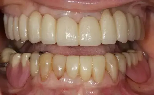 Close-up of teeth with visible gaps and discoloration in the lower front row