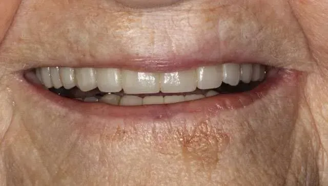 Close-up of a smiling mouth with visible white teeth and a small brown patch on the chin
