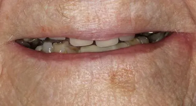 Close-up of a mouth with missing upper front teeth and stained lips.