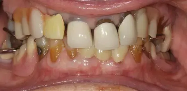 Close-up of teeth with heavy plaque buildup and crowding, showing yellow-brown discoloration and gum irritation