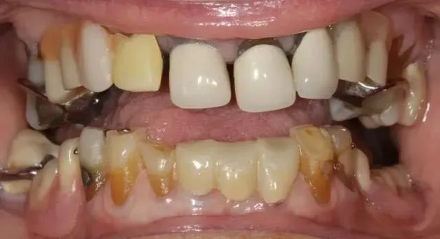 Close-up of a mouth showing heavily discolored and damaged upper and lower teeth