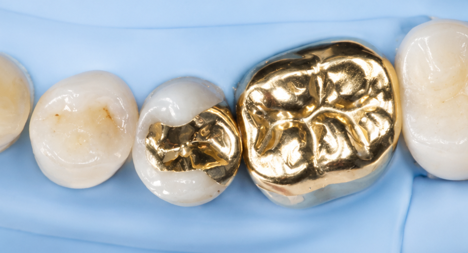 Dental close-up of white teeth and a shiny gold molar crown on a blue background