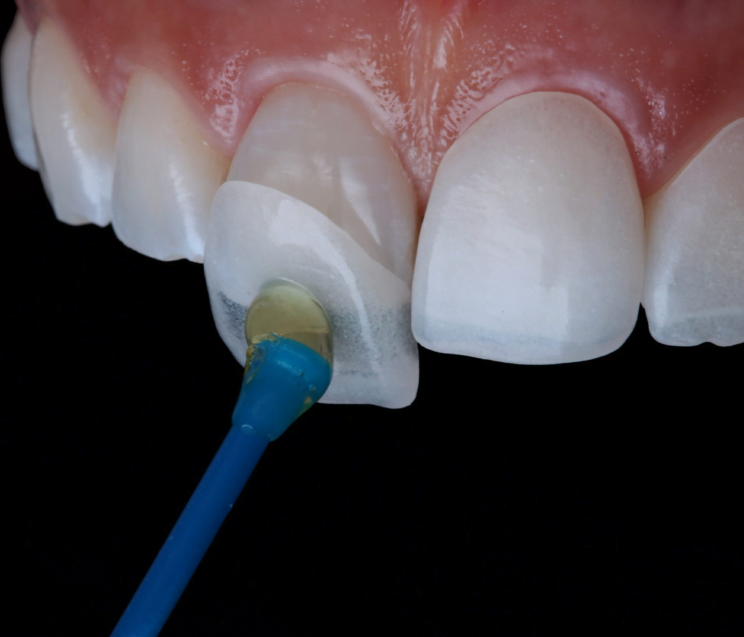 Placing a dental veneer on a front tooth
