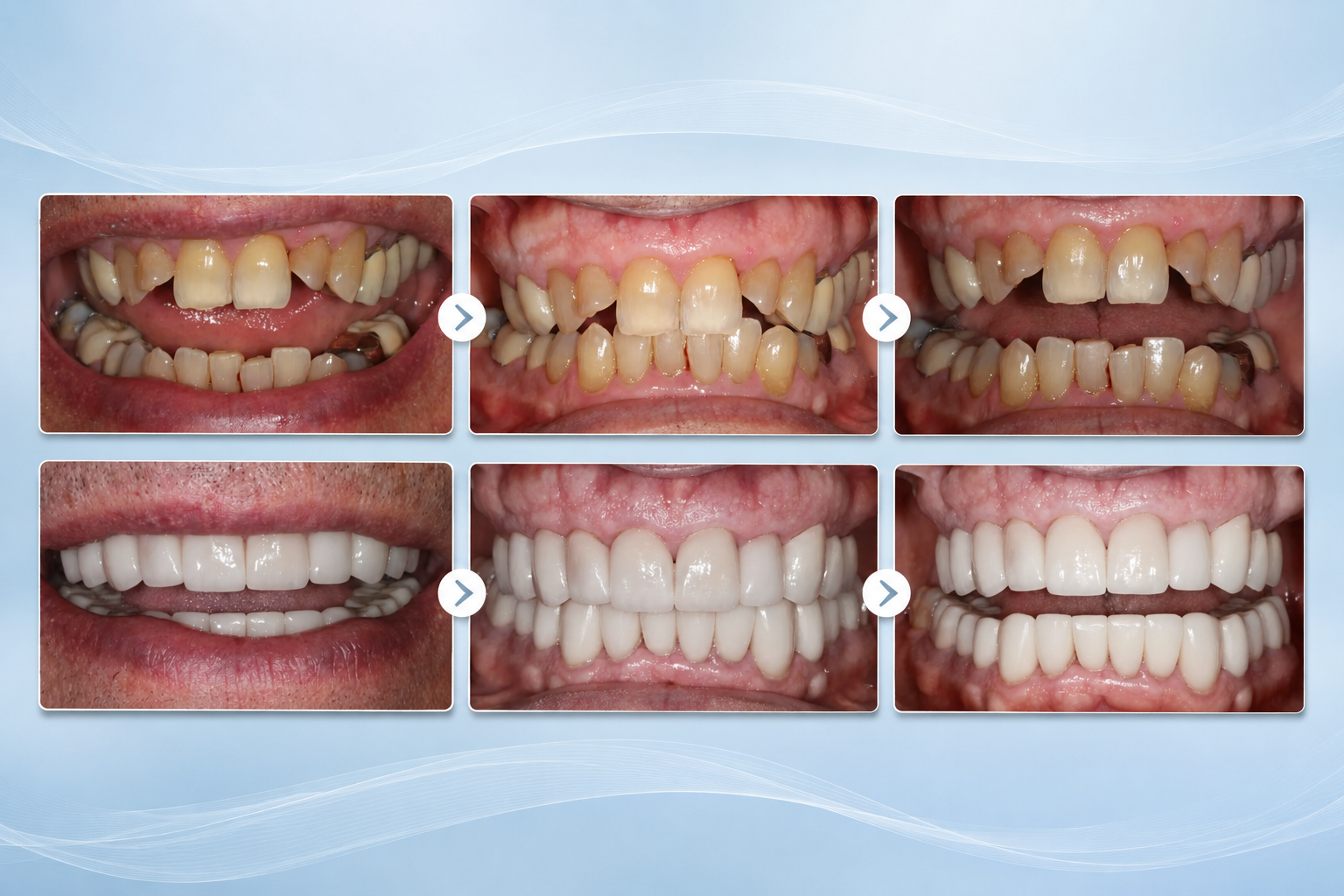 Before-and-after collage of teeth, showing dental correction from misaligned to straight, white smile.