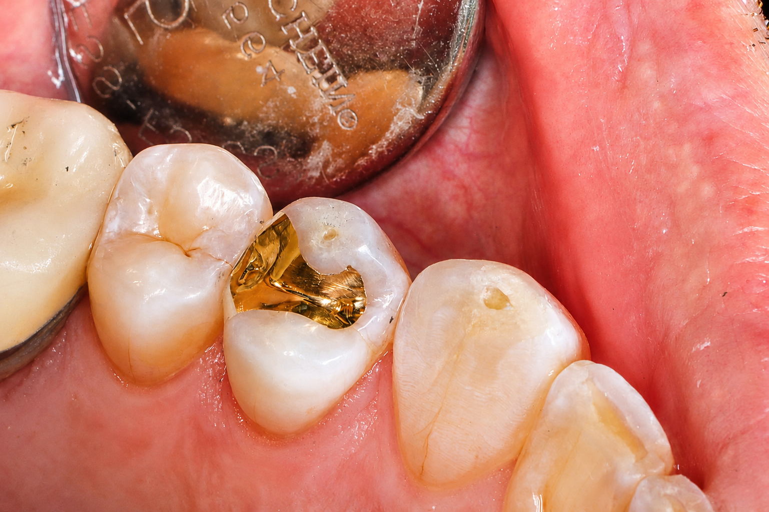Close-up of teeth with a gold dental filling and inflamed pink gums