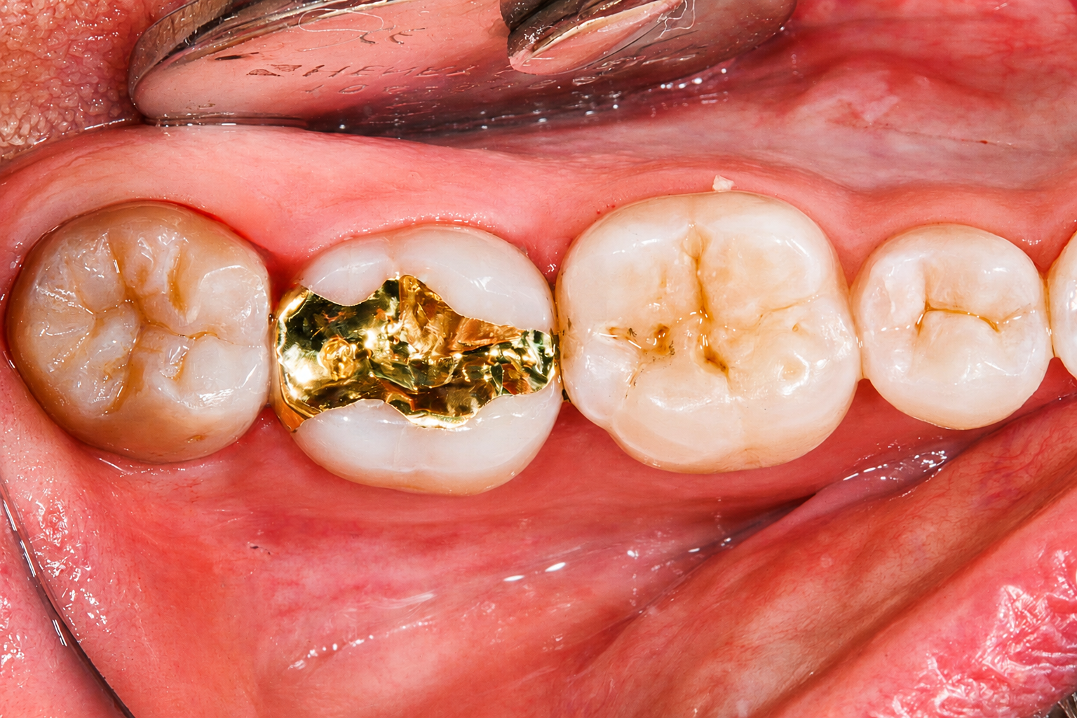 Close-up of teeth with a gold dental filling on one molar and stained enamel nearby