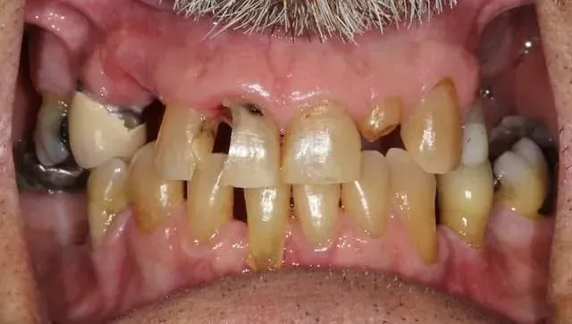 Close-up of heavily decayed, stained teeth and inflamed gums in an open mouth