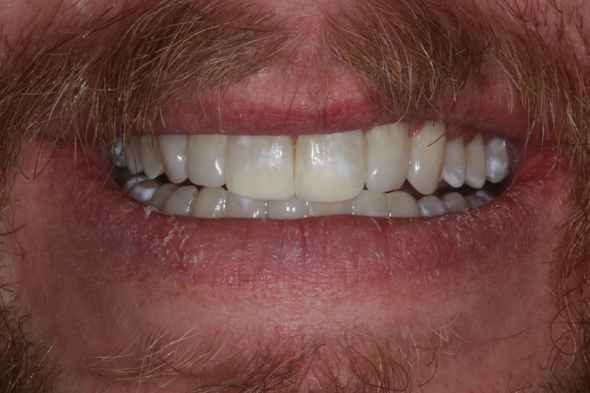 AFTER Invisalign treatment in New Holland, PA