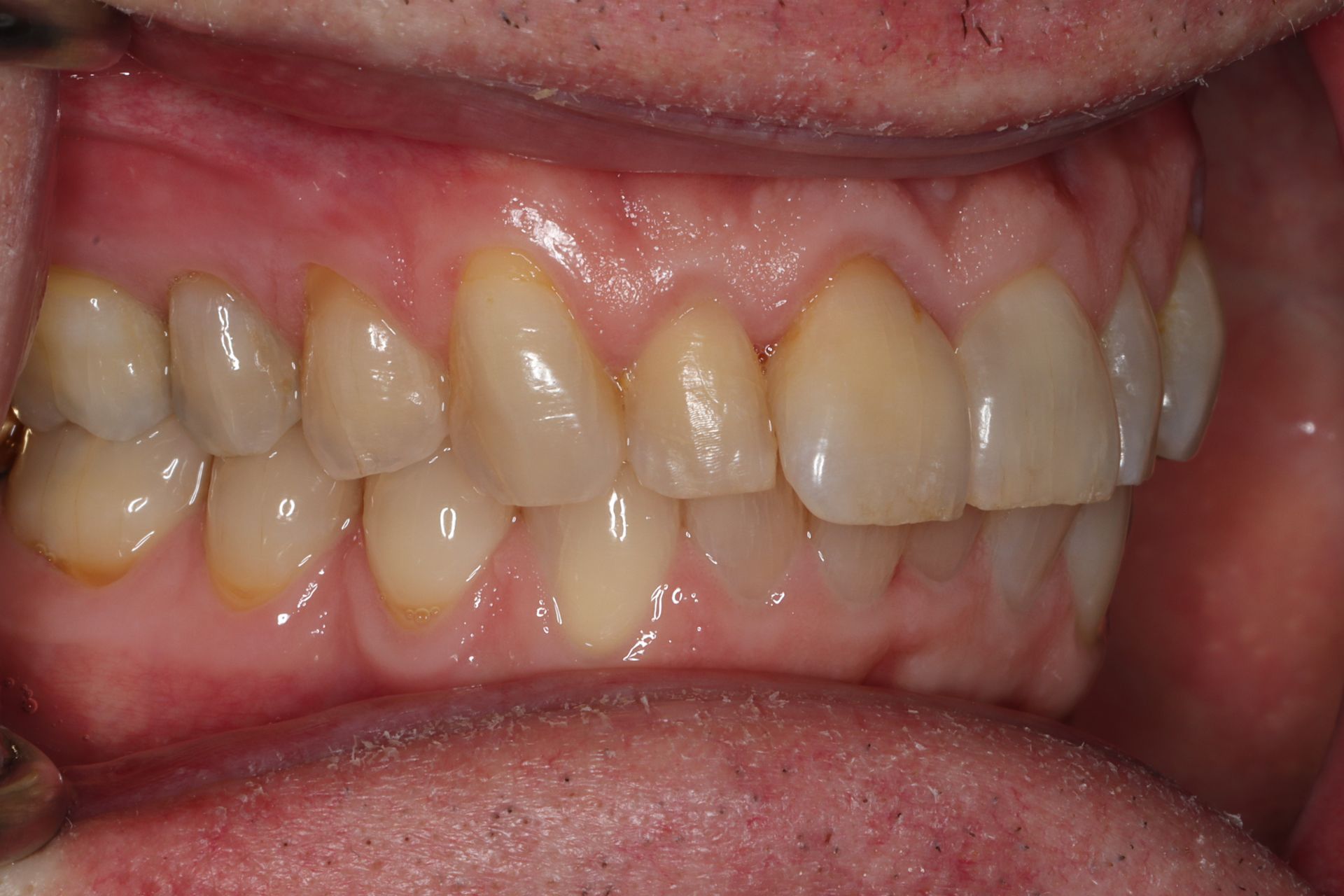 Close-up of teeth and gums showing crowded, misaligned front teeth with slight discoloration