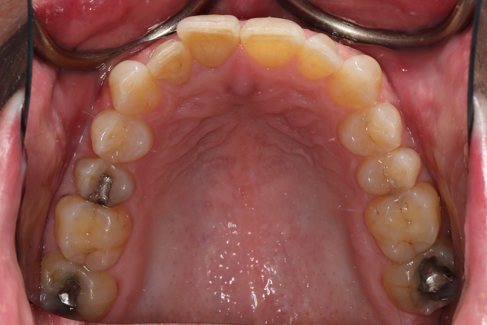 Upper dental arch with several teeth and dark fillings, viewed from the palate side.