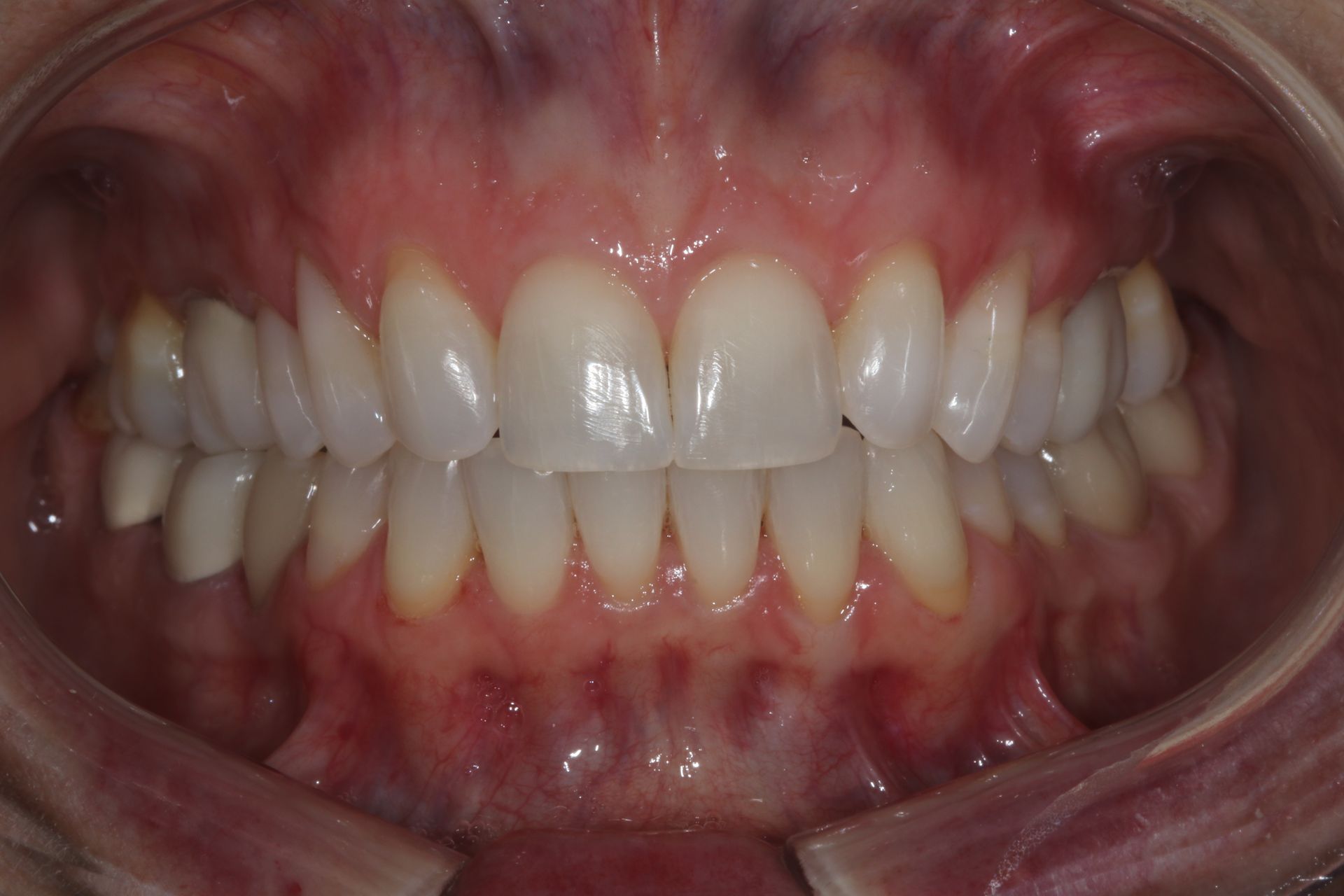 Close-up of a person’s teeth and gums, showing a full smile with braces-free front teeth.