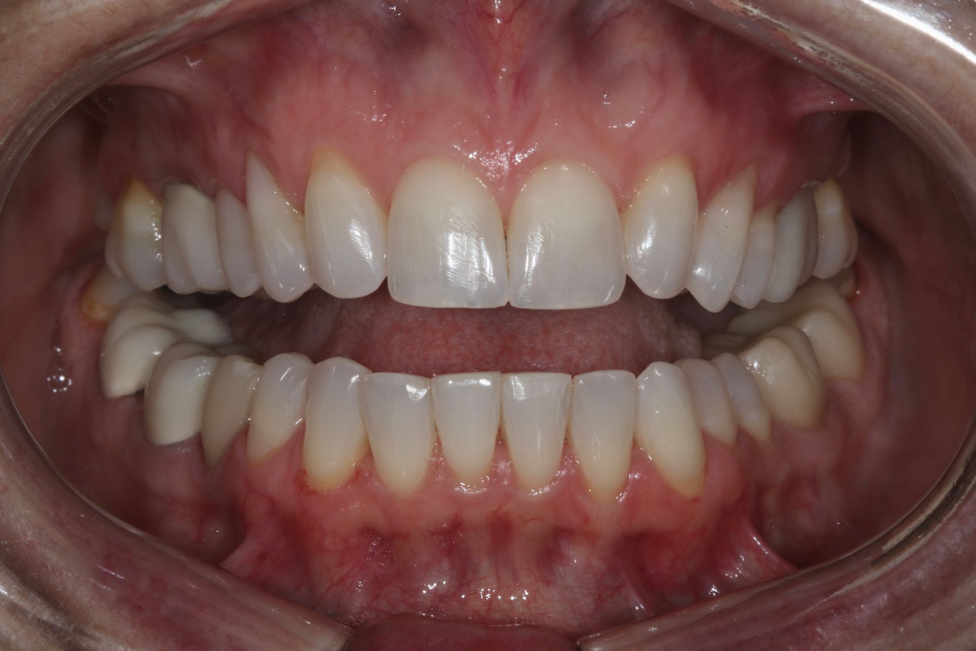 Close-up of a smiling mouth showing upper and lower teeth and gums