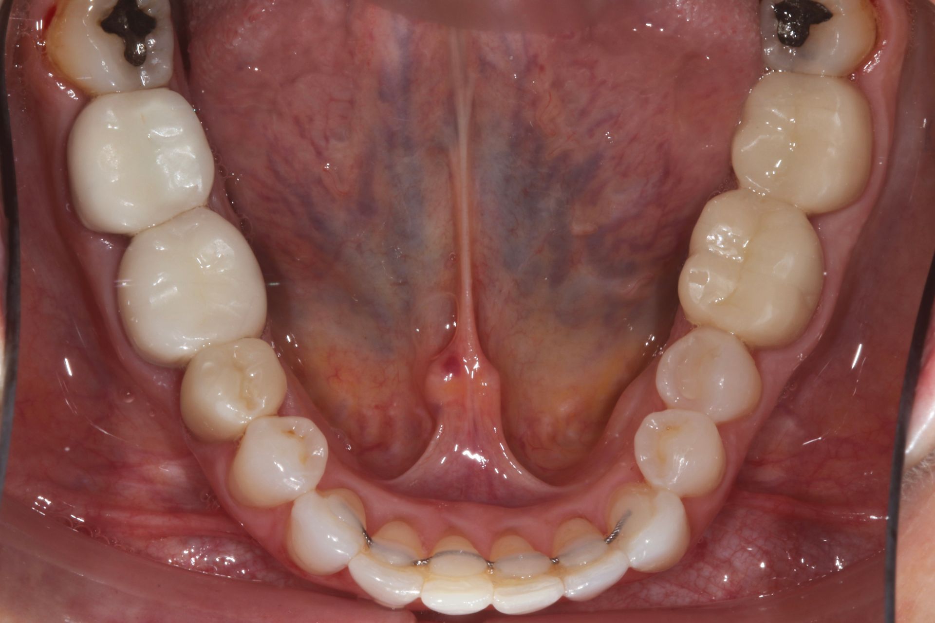 Close-up of the lower teeth and tongue in an open mouth, viewed from above.