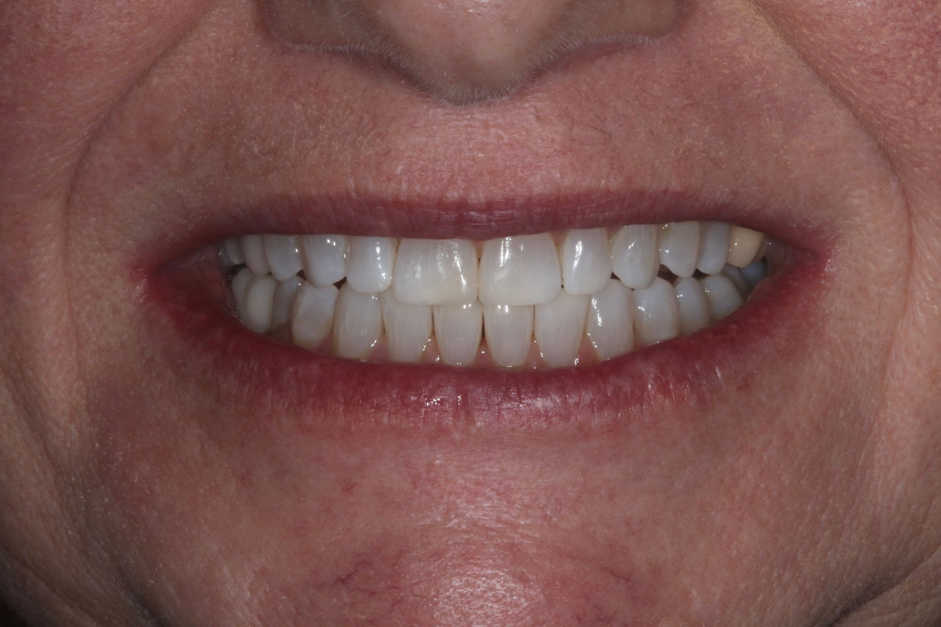 Beautiful AFTER smile patient had Invisalign New Holland, PA
