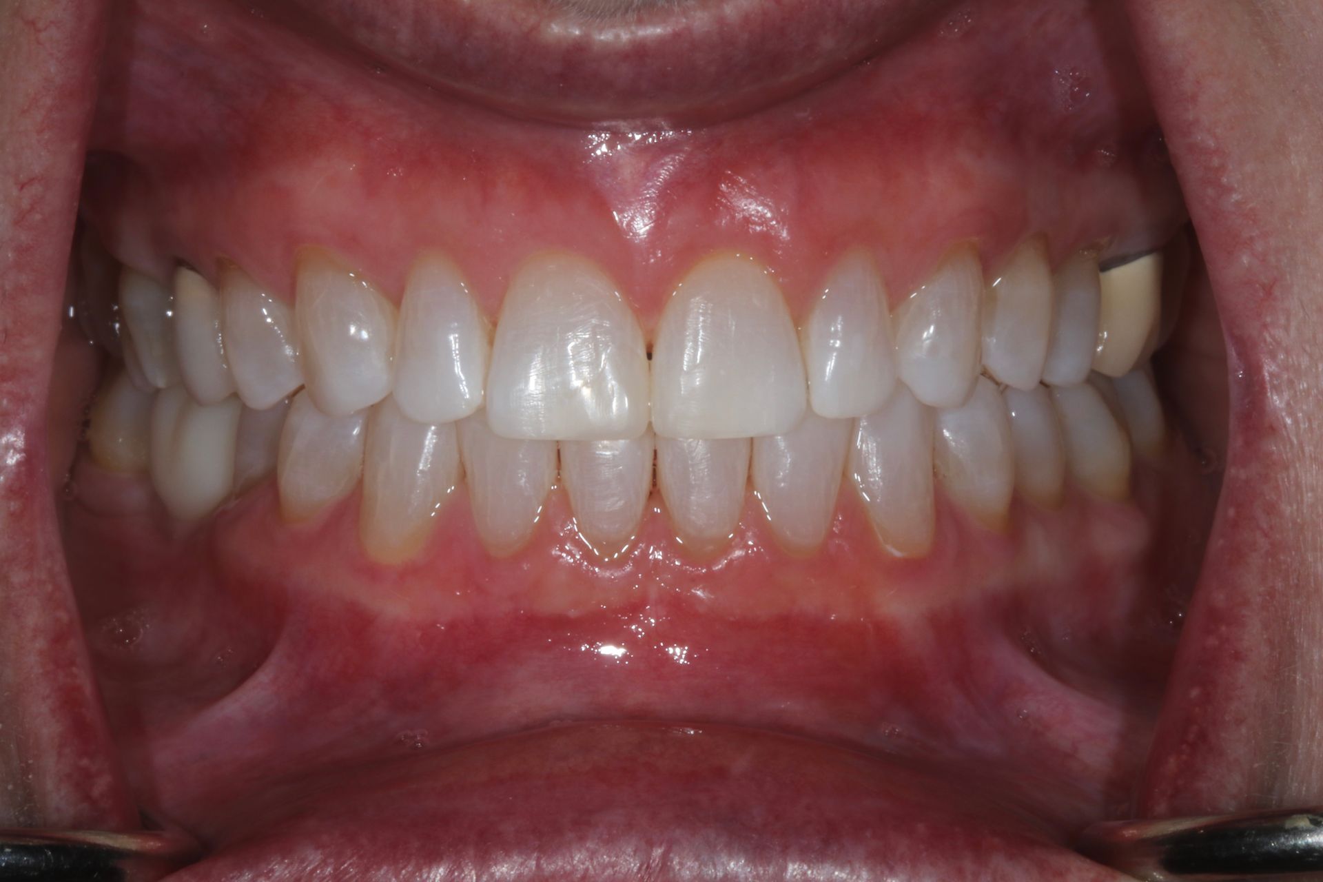 Beautiful AFTER smile patient had Invisalign New Holland, PA 2