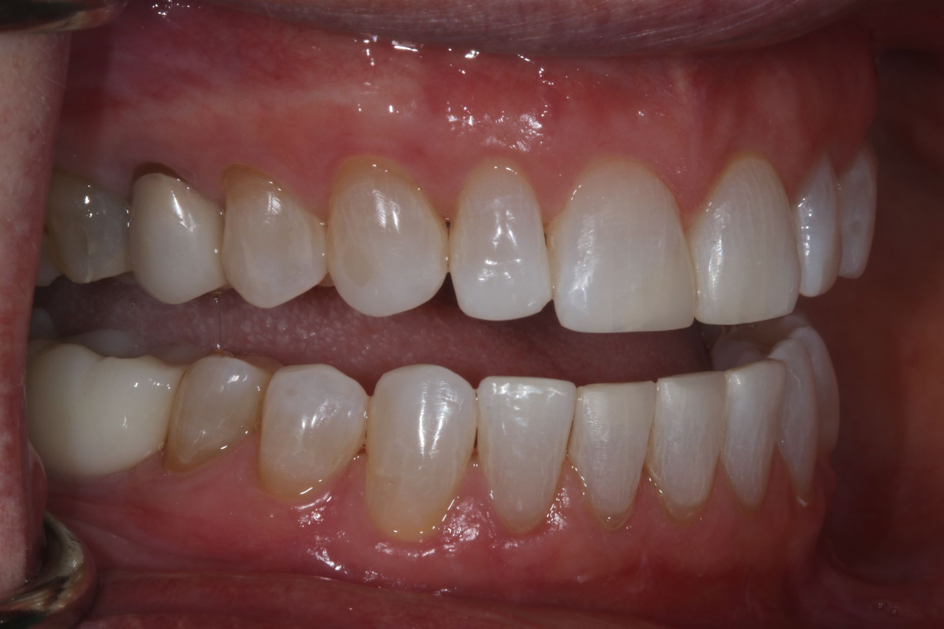 Beautiful AFTER smile patient had Invisalign New Holland, PA 4