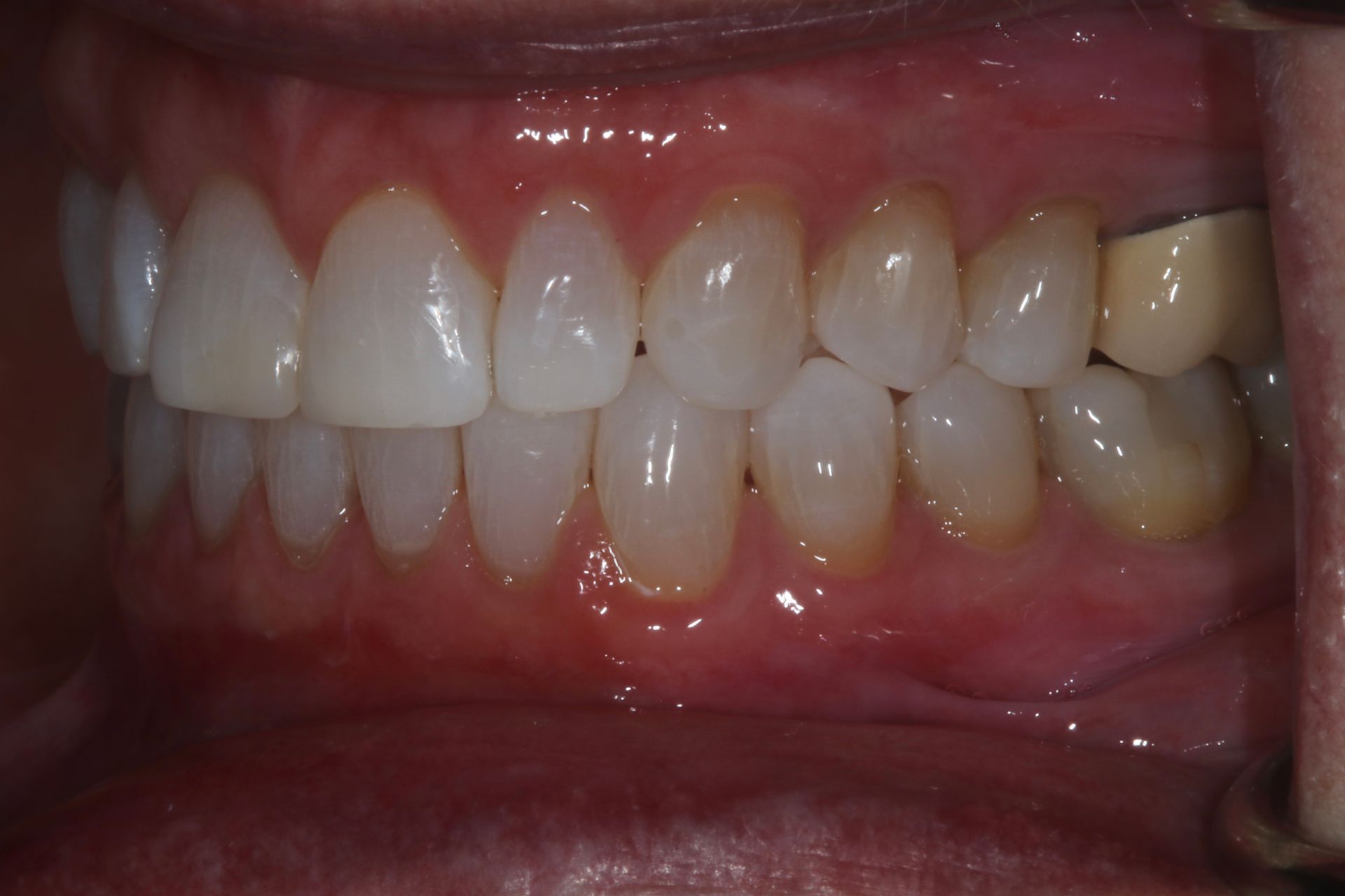 Beautiful AFTER smile patient had Invisalign New Holland, PA 3