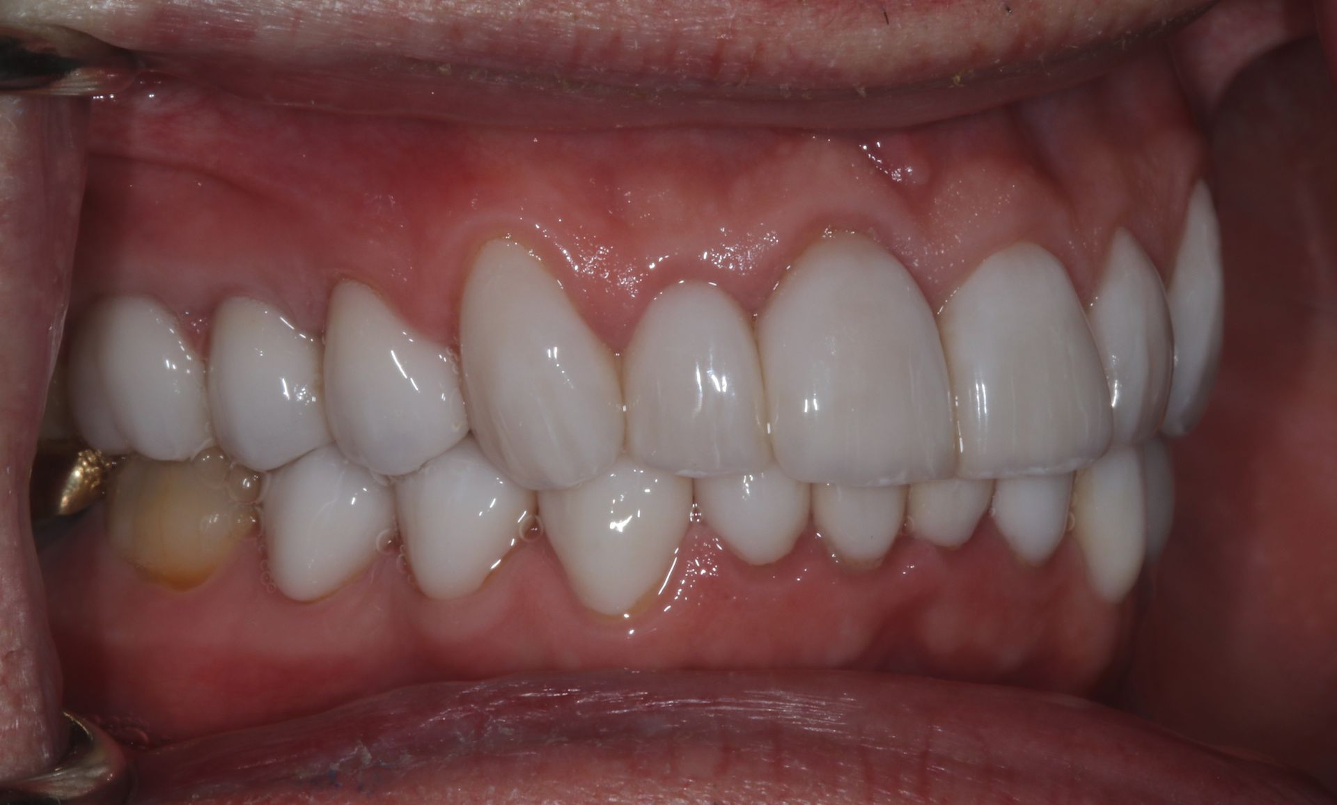 Close-up of a person’s teeth and gums with a visible yellowish tooth on the left side.