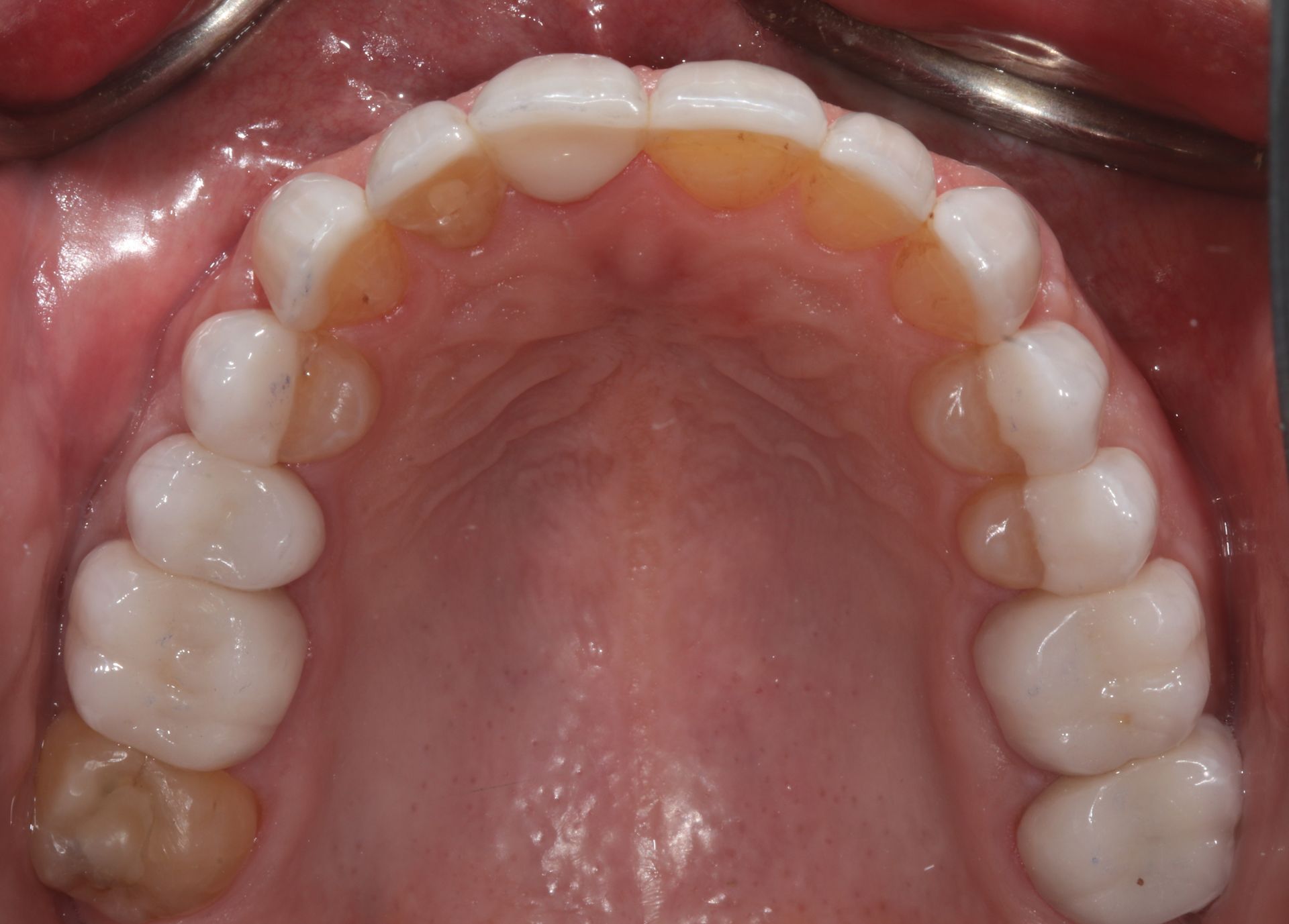 Close-up of the upper dental arch and palate, showing white teeth and pink gums.