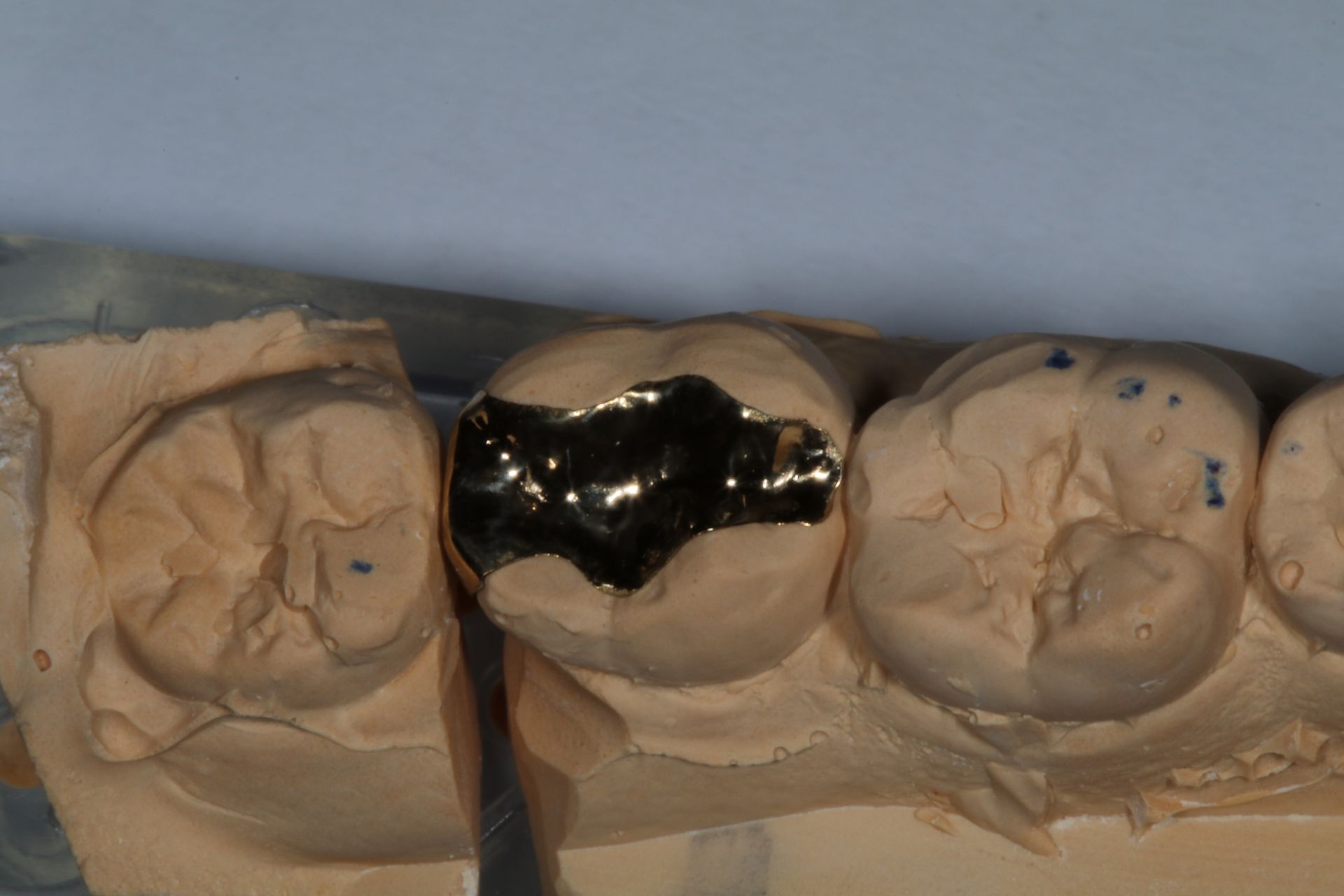 Dental models with a black filling or crown on the center tooth