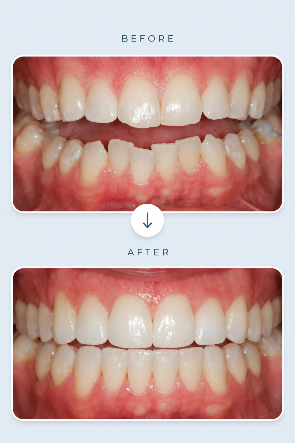 Before-and-after close-up of teeth alignment, showing a gap corrected into a straighter smile.