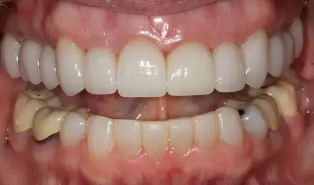 Close-up of a mouth with teeth clenched, showing a brown tooth and misaligned lower teeth.