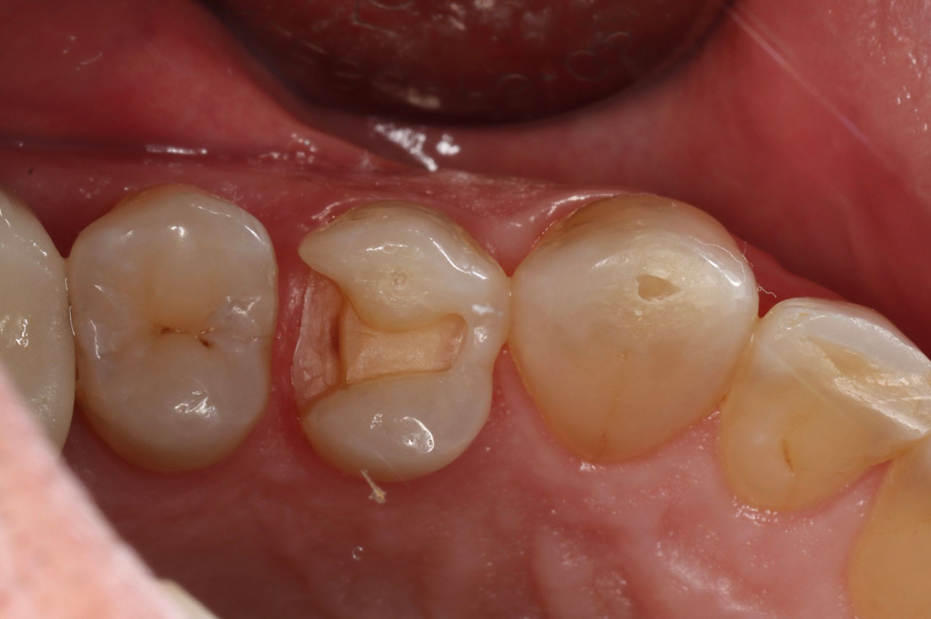 Close-up of molars with one tooth showing a small cavity and brown discoloration