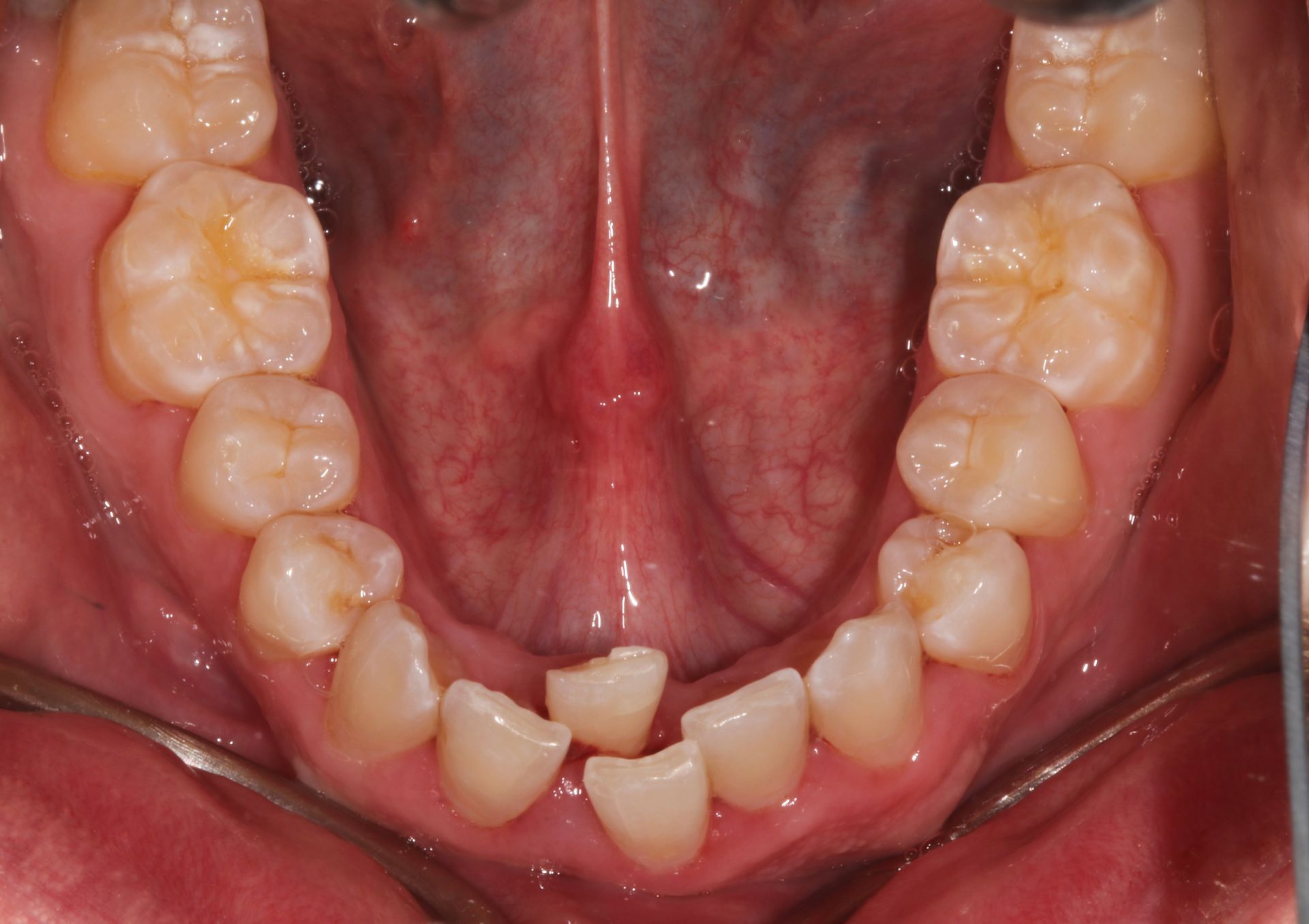 Invisalign treatment New Holland, PA dentist - BEFORE photo
