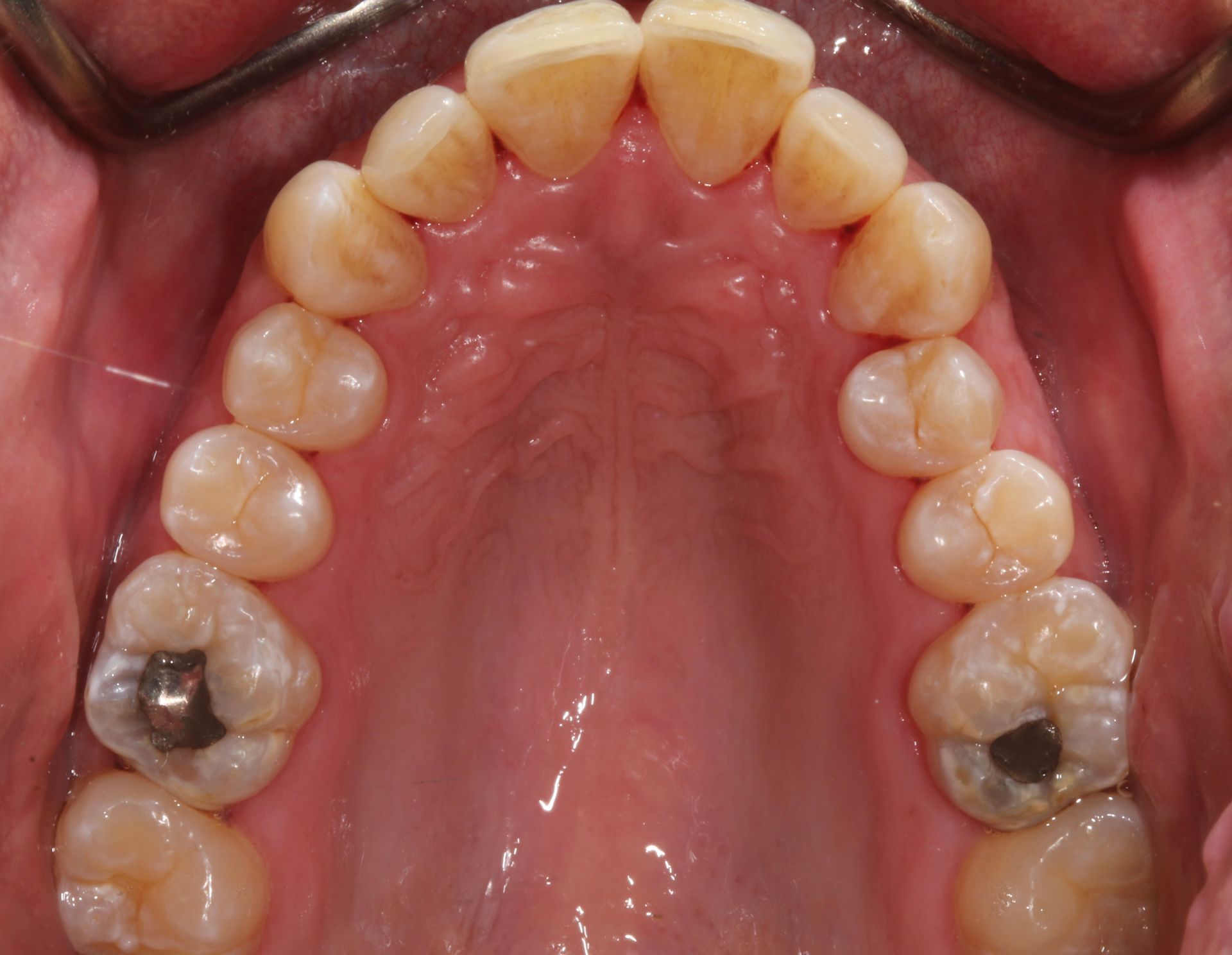 Invisalign treatment New Holland, PA dentist - BEFORE photo 2